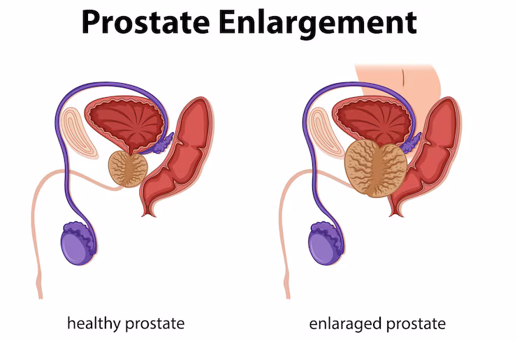 Prostate Enlargement Treatment